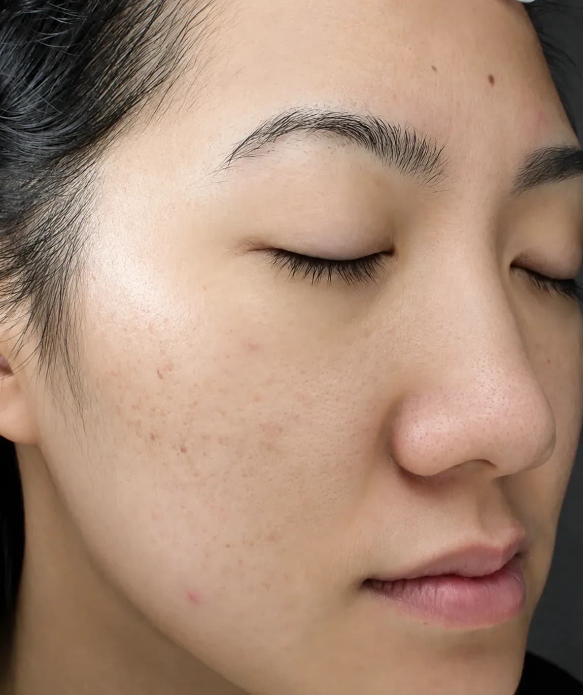 Acne facial treatment after