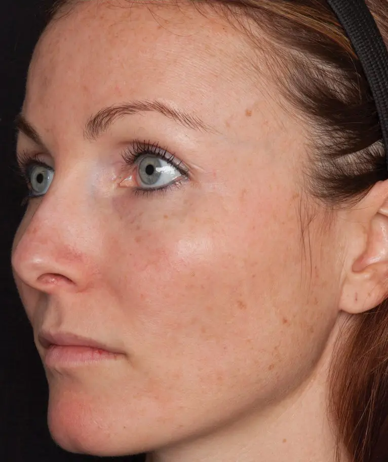 Chemical peel after treatment