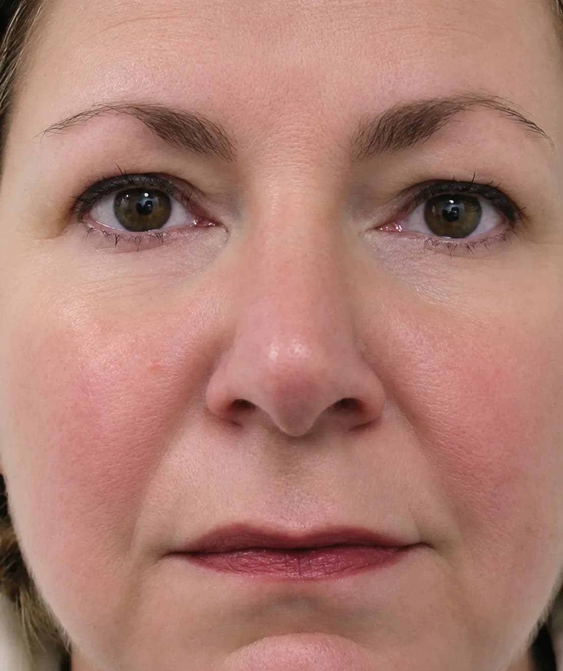 Redness facial treatment after