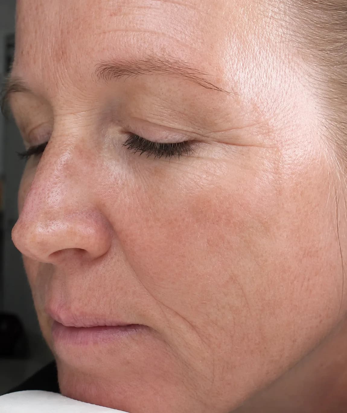 Wrinkle facial treatment after
