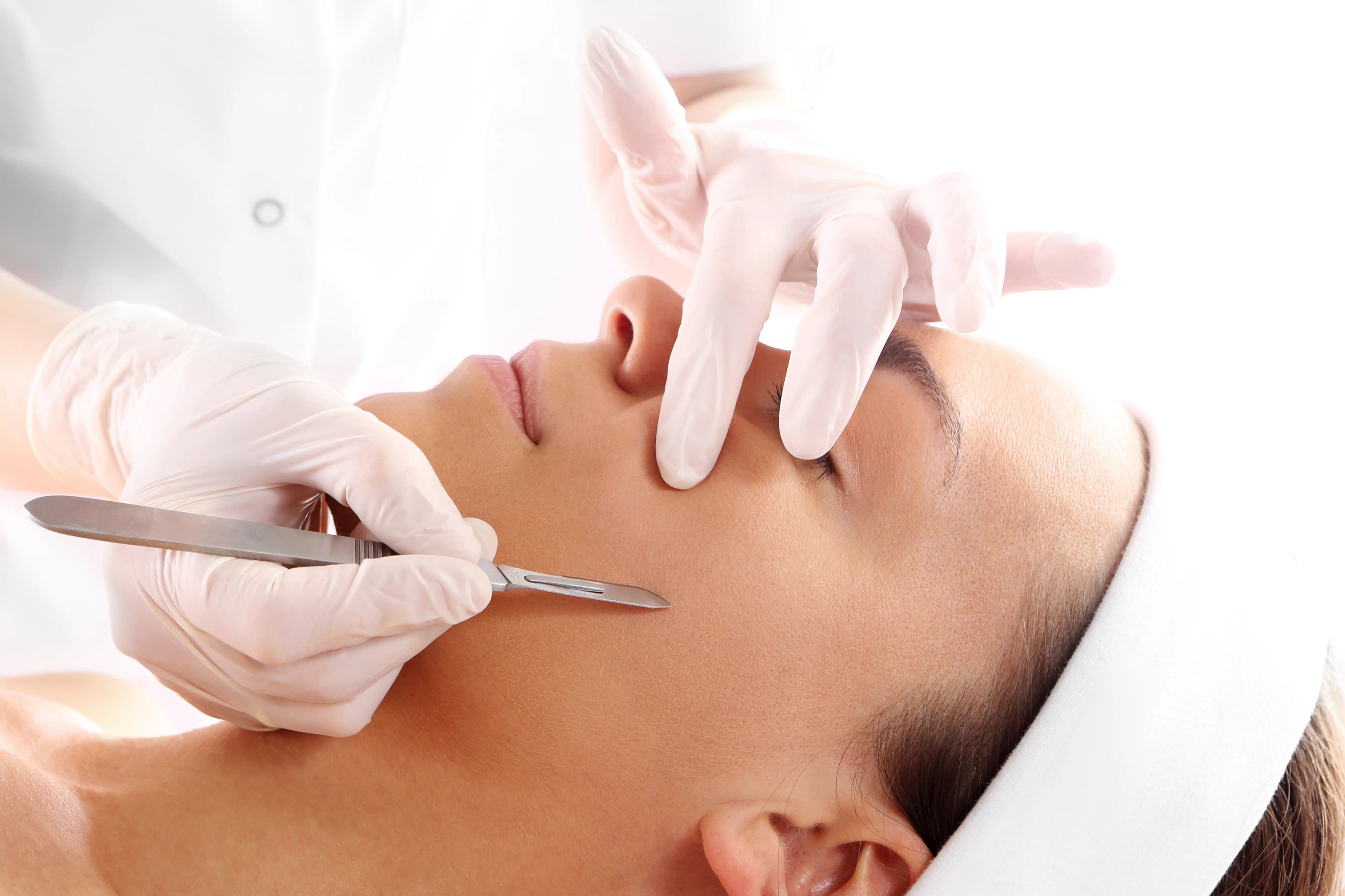 Does Dermaplaning Cause Acne?